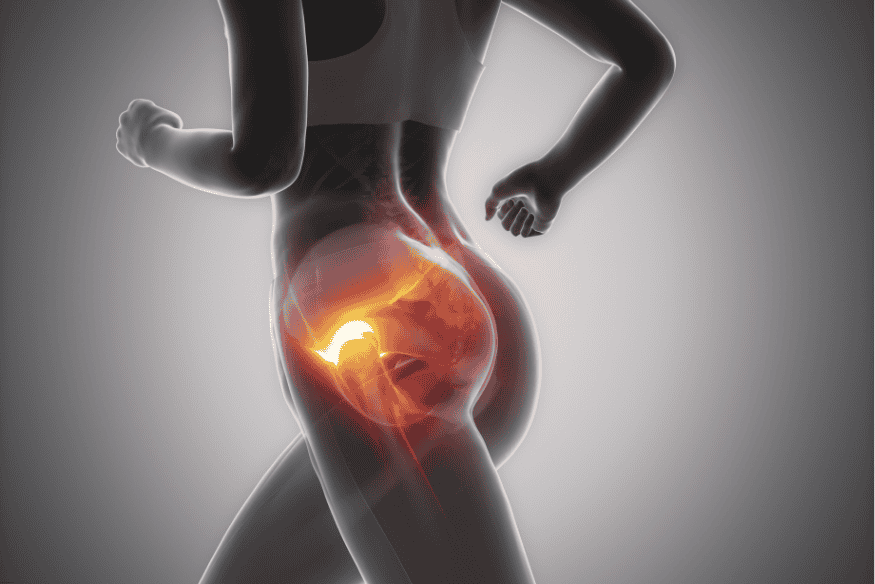 Ilustração de mulher correndo com destaque luminoso na região do quadril, indicando dor sacroilíaca.